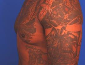 Gynecomastia Surgery Before & After Image