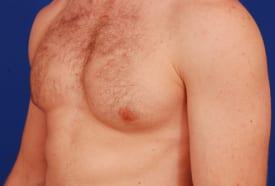 Gynecomastia Surgery Before & After Image