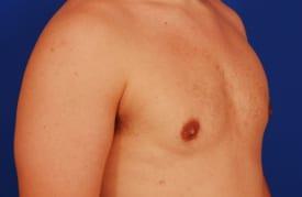 Gynecomastia Surgery Before & After Image
