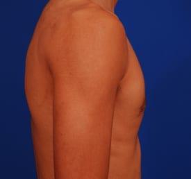 Gynecomastia Surgery Before & After Image