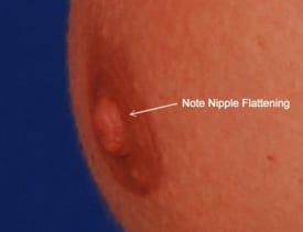 Gynecomastia Surgery Before & After Image