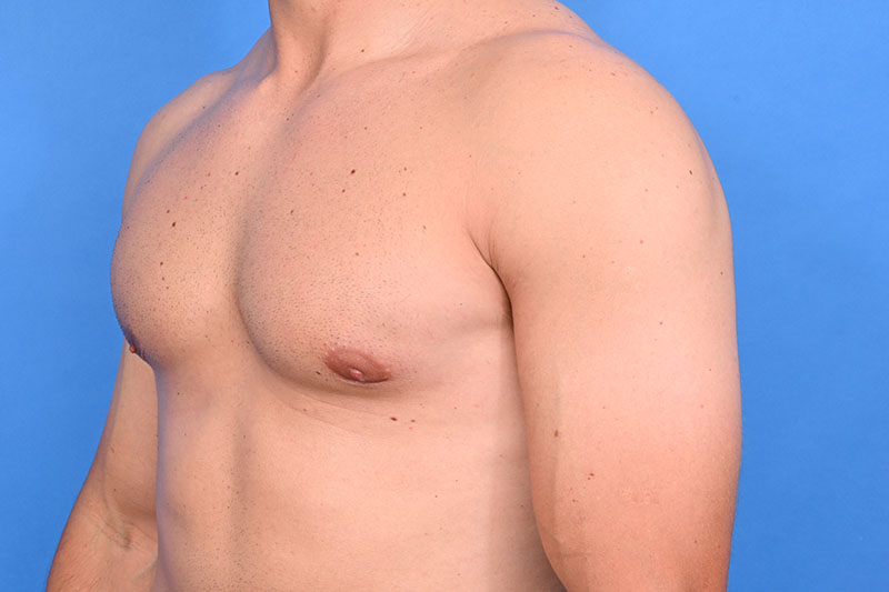 Gynecomastia Surgery Before & After Image