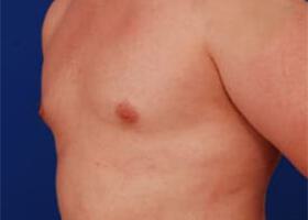 Gynecomastia Surgery Before & After Image