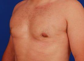 Gynecomastia Surgery Before & After Image