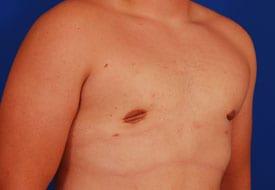 Gynecomastia Surgery Before & After Image