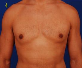 Gynecomastia Surgery Before & After Image