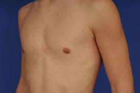 Gynecomastia Surgery Before & After Image