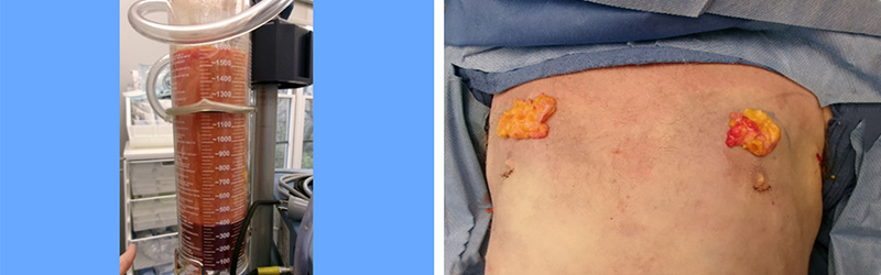 Close-up of chest after minimal incision gynecomastia surgery