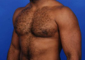 Austin Gynecomastia Surgery patient After