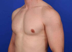 Austin Gynecomastia Surgery patient After