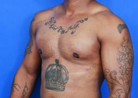 Austin Gynecomastia Surgery well-built patient After