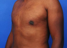 Austin Gynecomastia Surgery patient After
