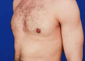 Austin Gynecomastia Surgery patient After