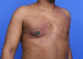 Austin Gynecomastia Surgery patient After 