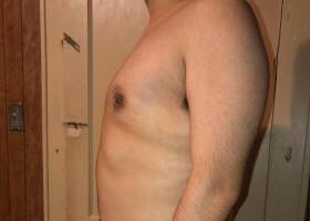 After Austin Gynecomastia Surgery patient