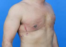 Revision Gynecomastia Surgery Before & After Image