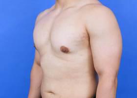 Revision Gynecomastia Surgery Before & After Image