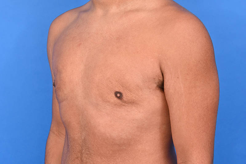Gynecomastia Surgery Before & After Image