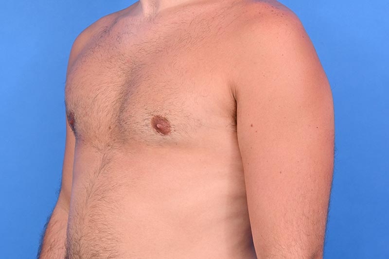 Gynecomastia Surgery Before & After Image