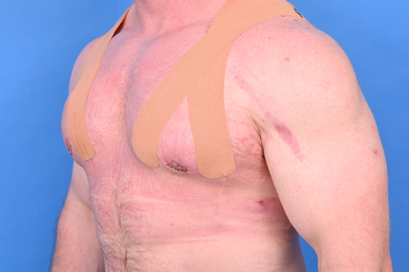 Gynecomastia Surgery Before & After Image