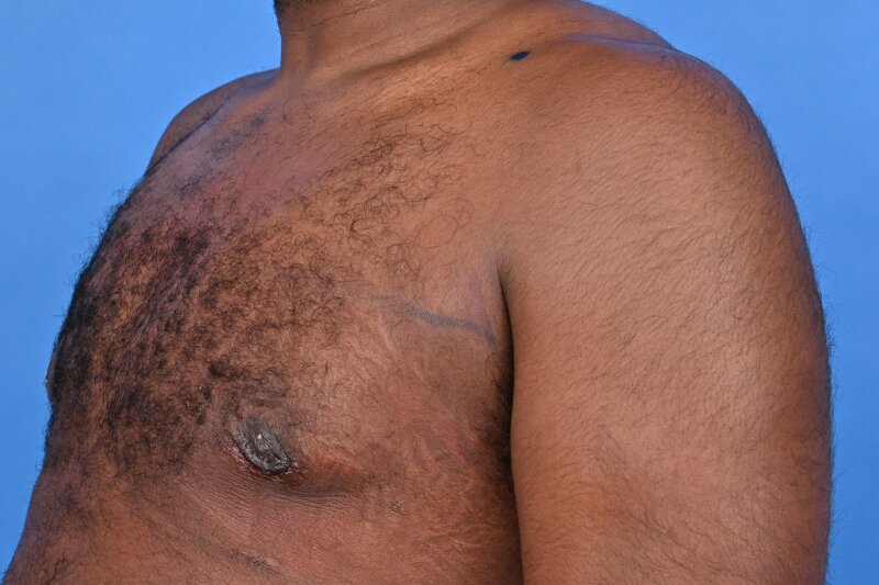 Gynecomastia Surgery Before & After Image