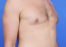 Revision Gynecomastia Surgery Before & After Image