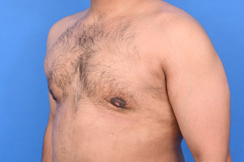 Gynecomastia Surgery Before & After Image