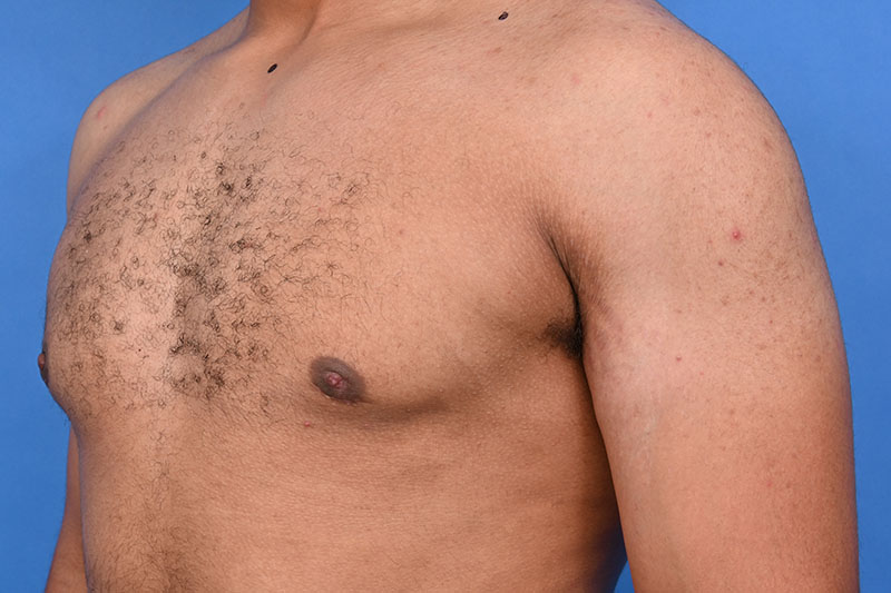 Gynecomastia Surgery Before & After Image