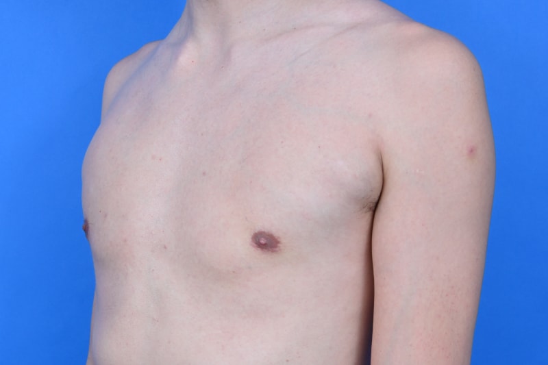 Gynecomastia Surgery Before & After Image