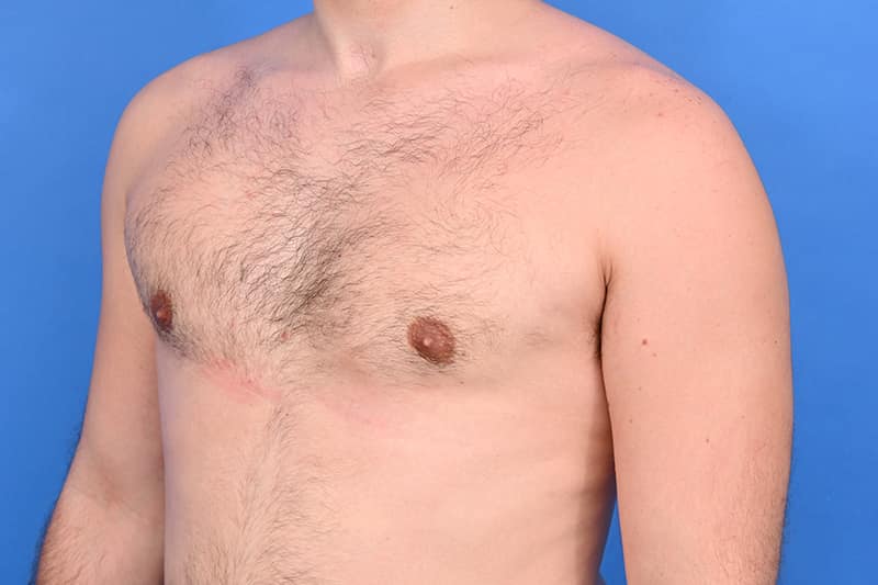 Gynecomastia Surgery Before & After Image