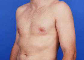 Revision Gynecomastia Surgery Before & After Image