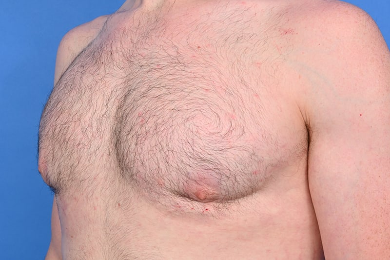 Gynecomastia Surgery Before & After Image