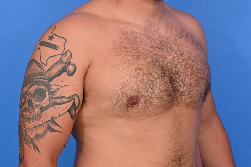 Gynecomastia Surgery Before & After Image
