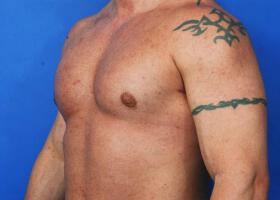 Revision Gynecomastia Surgery Before & After Image