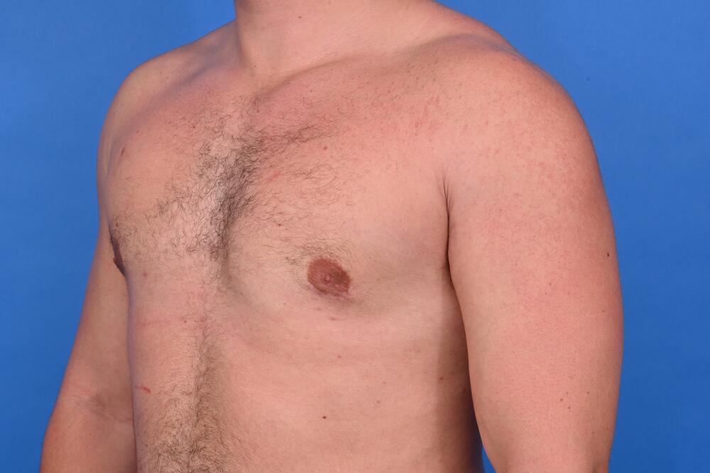 Gynecomastia Surgery Before & After Image