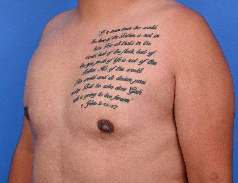 Gynecomastia Surgery Before & After Image