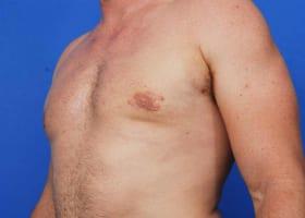 Revision Gynecomastia Surgery Before & After Image