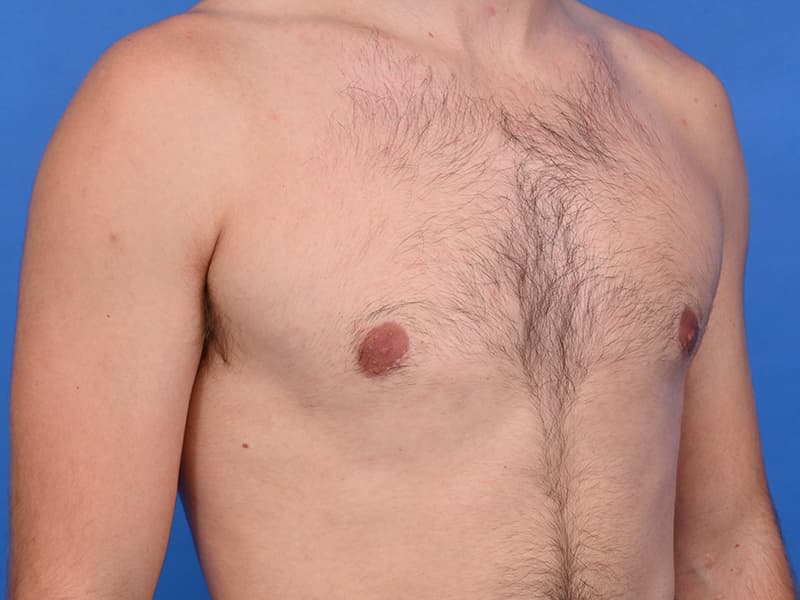 Gynecomastia Surgery Before & After Image