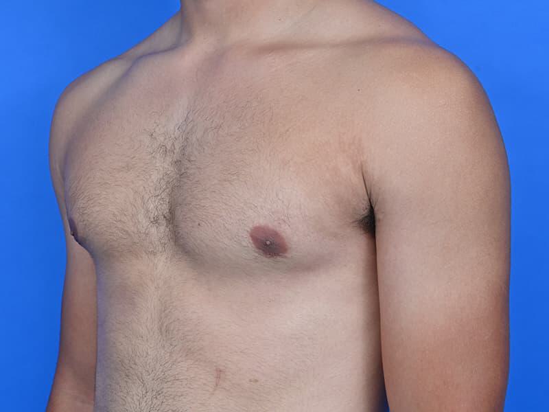 Gynecomastia Surgery Before & After Image