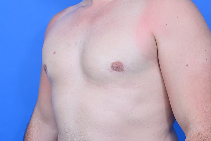 Gynecomastia Surgery Before & After Image