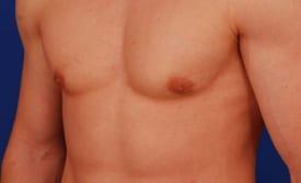 Revision Gynecomastia Surgery Before & After Image