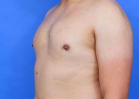 Gynecomastia Surgery Before & After Image