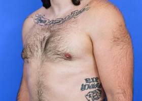 Gynecomastia Surgery Before & After Image