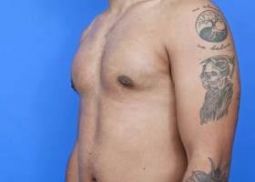Gynecomastia Surgery Before & After Image