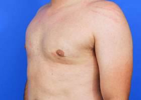 Gynecomastia Surgery Before & After Image
