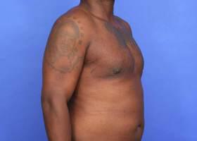 Gynecomastia Surgery Before & After Image