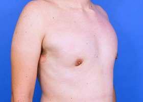 Gynecomastia Surgery Before & After Image