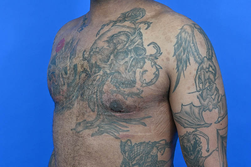 Revision Gynecomastia Surgery Before & After Image