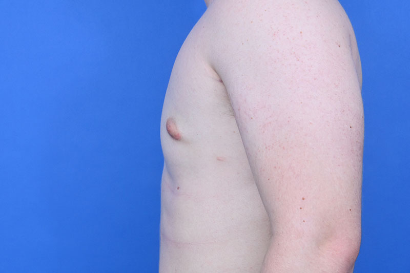 Gynecomastia Surgery Before & After Image