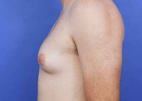 Gynecomastia Surgery Before & After Image